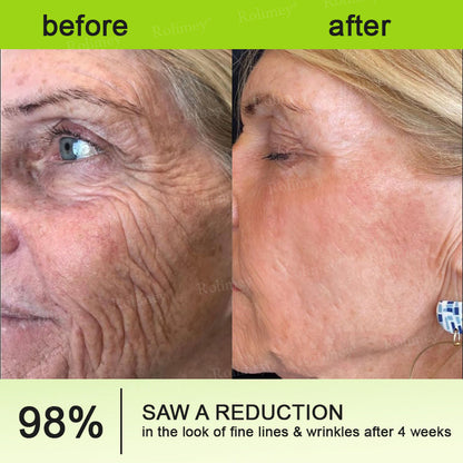 🍈Made and shipped from Australia 💫Rolimey® Botox & Vita-A Retinol Shot Wrinkle-Lift Tightening cream - Last Day Promotion 70% OFF