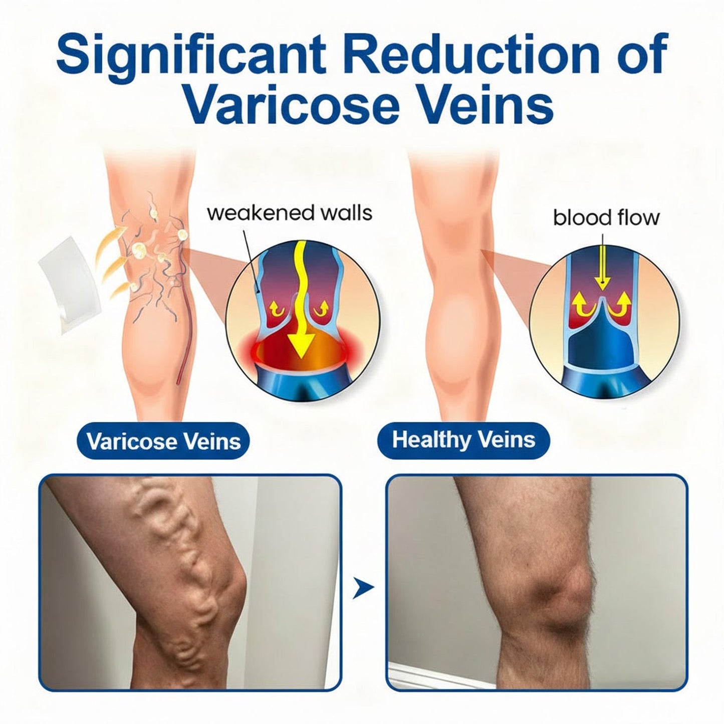🇦🇺👨‍⚕️✅GFOUK® VeinEase Microneedle Care Patch⚡Instant Relief, Long-Term Results