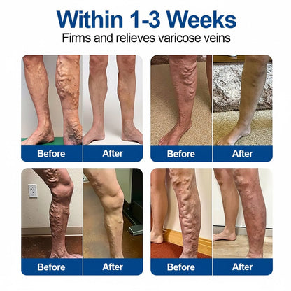 🇦🇺👨‍⚕️✅GFOUK® VeinEase Microneedle Care Patch⚡Instant Relief, Long-Term Results