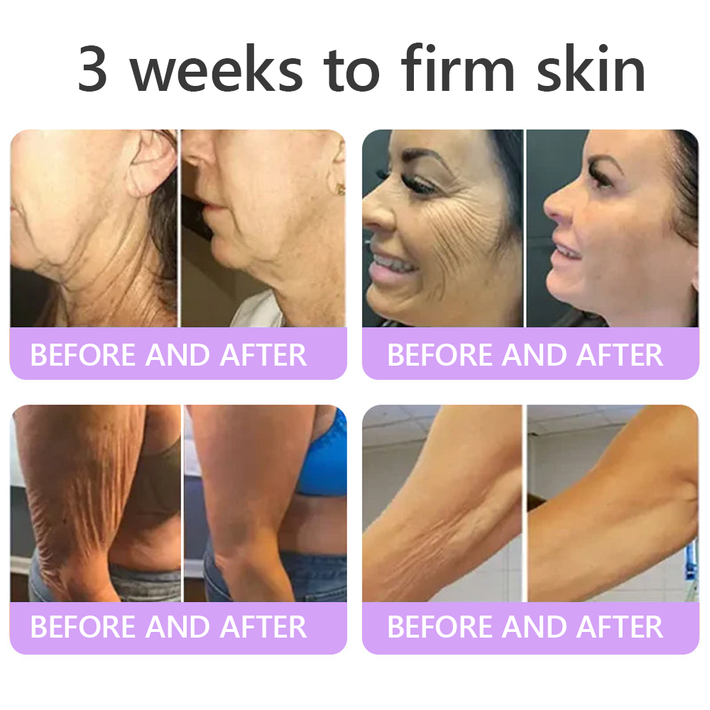 🔥Made and shipped from Australia 💫Rolimey® PDRN Multi-Peptide Massaging Roller Cream - Anti-aging, Hydrating, Skin Firming & Lifting, Skin Repair, Even Tone, Acne and Dark Spot Treatment, Wart and Mole Removal, and Psoriasis Relief.